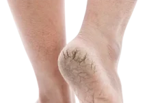 Monsoon Care Tips: ਇਹ 5 ਘਰੇਲੂ ਨੁਸਖਿਆਂ ‘ਚ ਫੱਟੀਆਂ ਅੱਡੀਆਂ ਨੂੰ ਠੀਕ ਕਰਨ ਦਾ ਇਲਾਜ